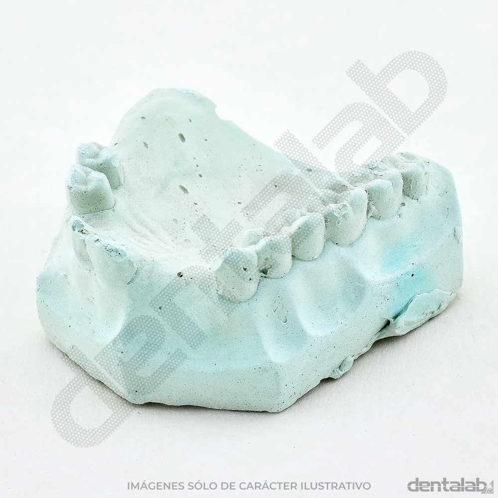 Modelo de Yeso Parcialmente Dentado x Par