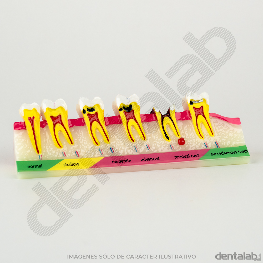 Modelo Progresión de Caries