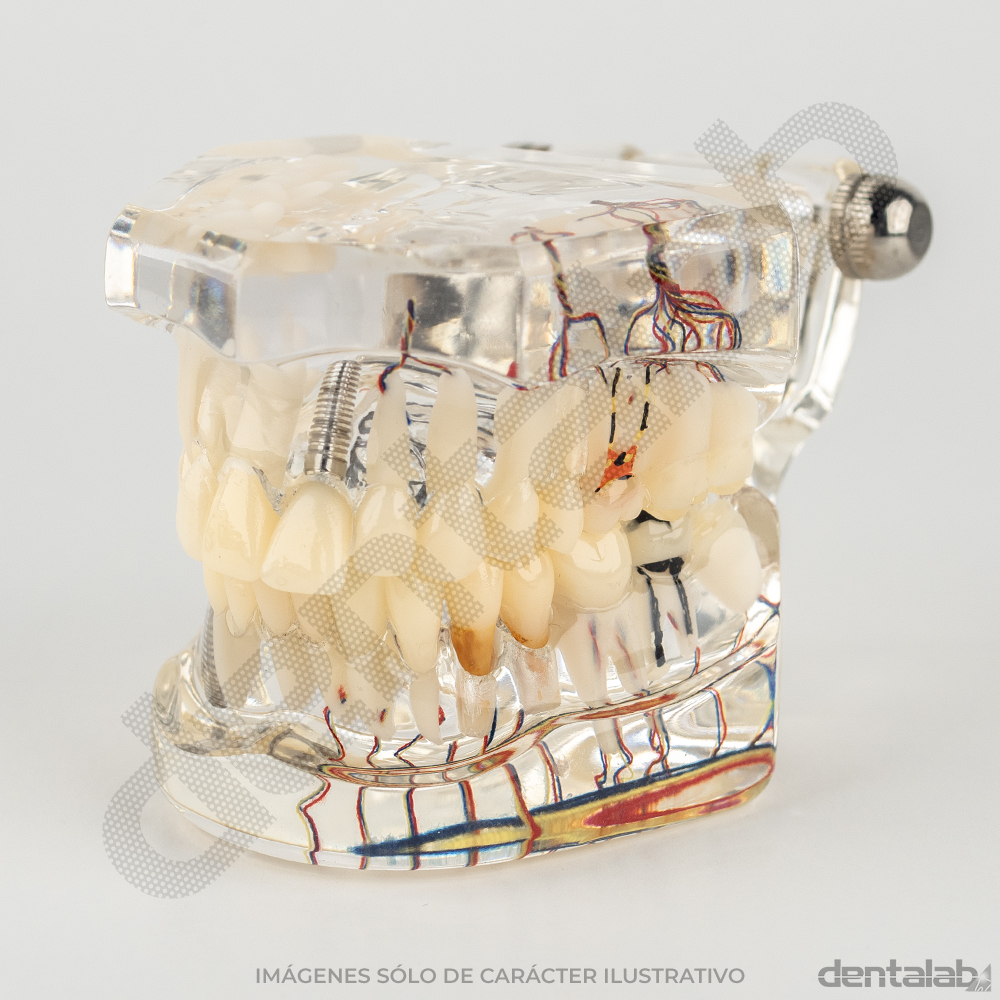 Modelo Transparente de Implante con Nervio