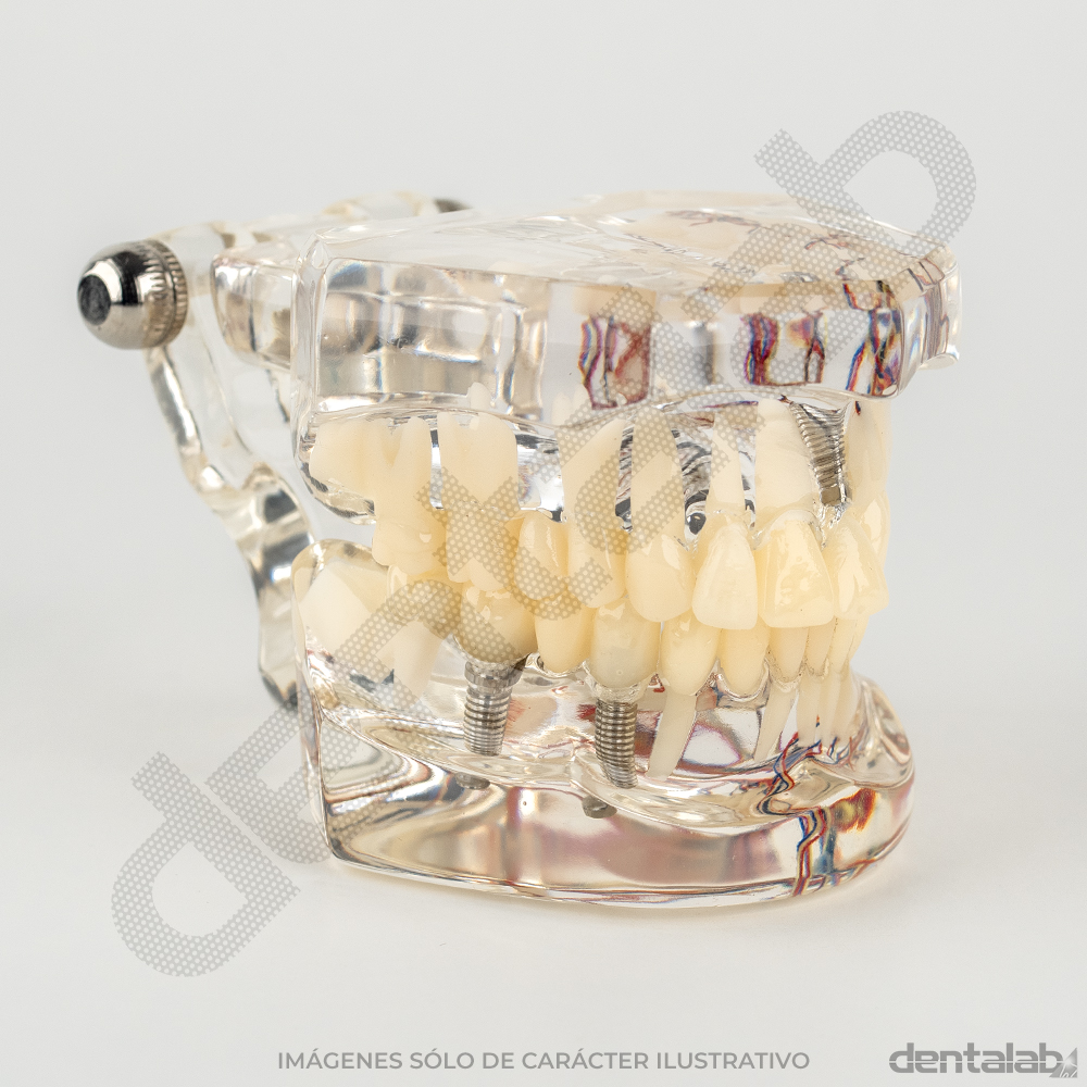 Modelo Transparente de Implante con Nervio