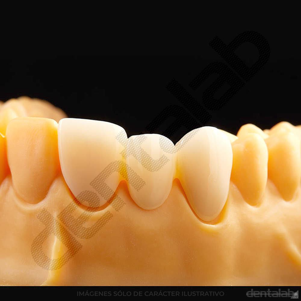 Disco de Zirconio RONDCERA SHT-ML PRO 3D A3 98 X 12mm